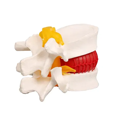 Produktbild von Lendenwirbelsäulen-Bandscheibenvorfall-Demonstrationsmodell, anatomisches 3D Wirbelsäulen-Lehrmodell, pathologisches Lehrmittel für Medizin