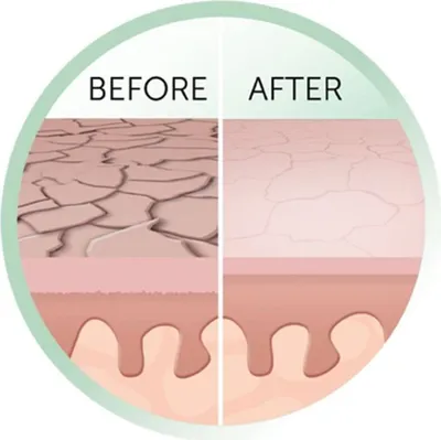 Image de Mikrodermabrasion au diamant REVEAL