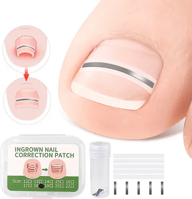 A close-up of a toe with an ingrown nail correction patch applied, along with a package of the patches and a tool.