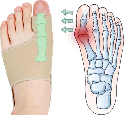 Produktbild von Ballenzehen-Korrektor für Frauen und Männer, Ballenzehen-Socken, Zehenspreizer, bequem und atmungsaktiv für Tag-/Nacht-Unterstützung, Hallux Valgus-Schmerzlinderung, rutschfester Großzehen-Glätter, beige