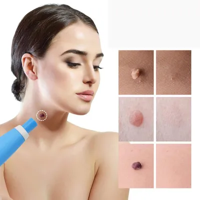Produktbild von Stielwarzen Entferner, Skin Tag Entferner, 2 in 1 Stielwarzen Entfernen schnell, Skin Tag Remover Kit Stielwarzen Set Für Fibrome von 2-8,5 mm