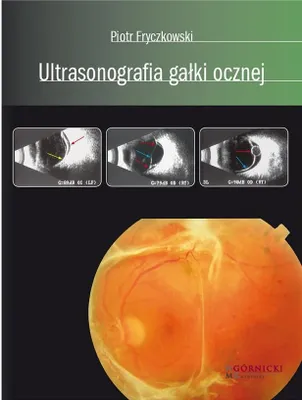 Image de Ultrasonographie du globe oculaire