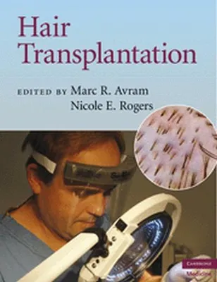 Produktbild von Hair Transplantation