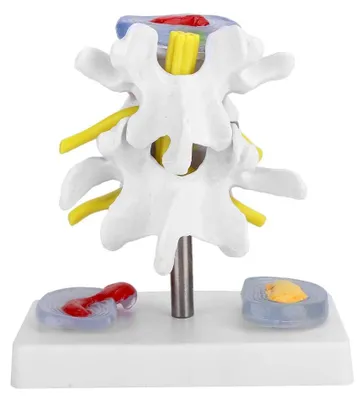 Productafbeelding van Lumbaal wervelmodel - Menselijk anatomisch skeletmodel - 2 zieke tussenwervelschijven - Veilig op voet - Gedetailleerde weergave - Ideaal voor medische opleiding - Herniamodel