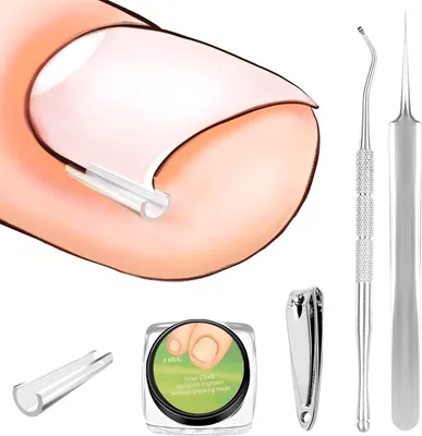 Produktbild von 60 Stück Eingewachsene Zehennägel Set, Zehennagelkorrektur für Eingewachsene Zehennägel, Zehennagel Korrektur Patch, Korrektor Pediküre Werkzeugen Mit Nagelknipser, Nagelzange, Pinzette
