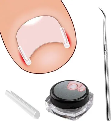 Image de Kit pour corriger les ongles incarnés – 40 bandes indolores pour lisser les ongles des orteils avec un levier pour ongles