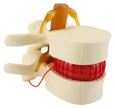 Obrázek produktu pro Anatomický model bederní páteře pro demonstraci hernií