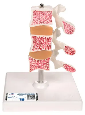 Osteoporose-Modell, 3 Lendenwirbel, Luxusmodell, auf Stativ