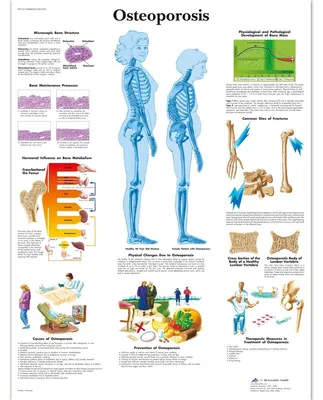 Osteoporose-Anatomieposter, gelaminiert, 50,8 x 63,5 cm