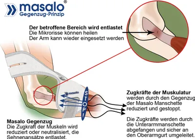 An illustration showing how a Masalo elbow brace works to relieve pressure on the affected area.