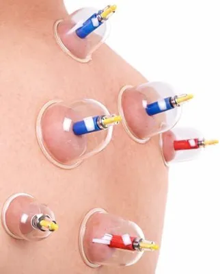 Produktbild von Hijama-Set, 12-teilig, hochwertige Ausführung