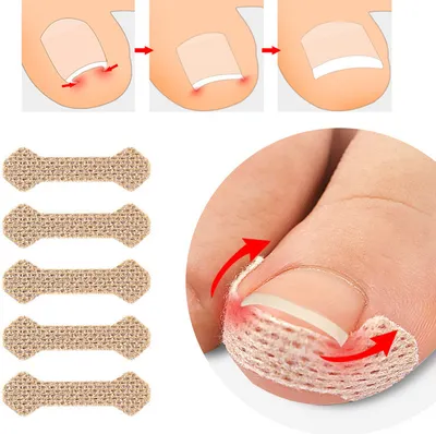 Produktbild von INF Pflaster für eingewachsene Zehennägel Beige