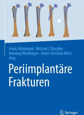 Produktbild von Periimplantäre Frakturen