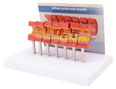Atherosklerose-Modell, Arterienpathologie, anatomisches Lehrmaterial