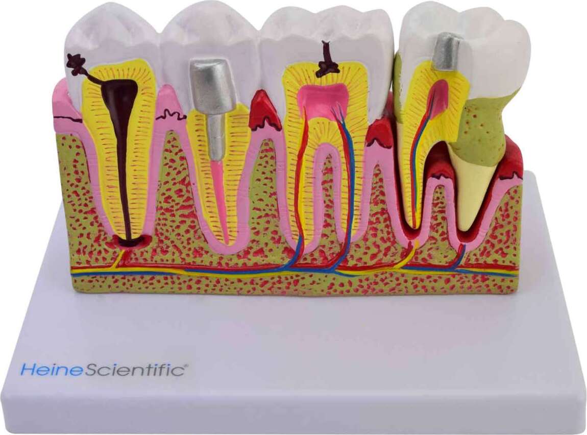 HEINESCIENTIFIC Modell mit erkrankten Backenzähnen 1 Stück 139029