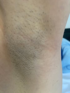 HaarIosy IPL, IPL-Haarentferner, Lumea IPL, IPL Laser, IPL Haarentfernung, Lumea IPL, Schmerzfreie Haarentfernungsgerät, 999,999 Lichtimpluse, Kunden-Foto 2