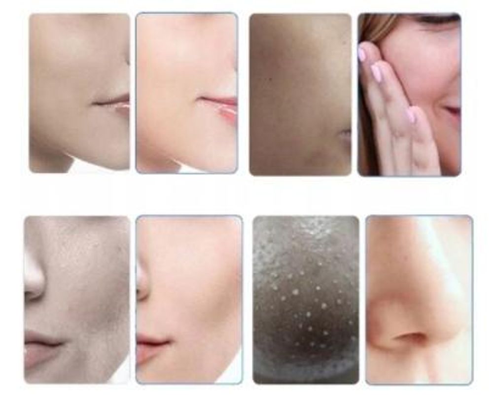 Idradermabrasione idrogeno purificazione ossigeno infusione 7in1 cavitazione peeling maschera combo