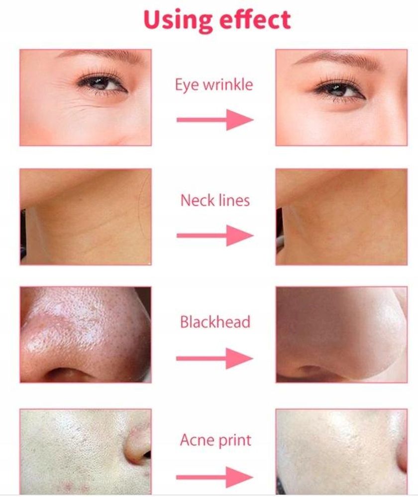 Microdermabrasion Diamant lifting fort 100W