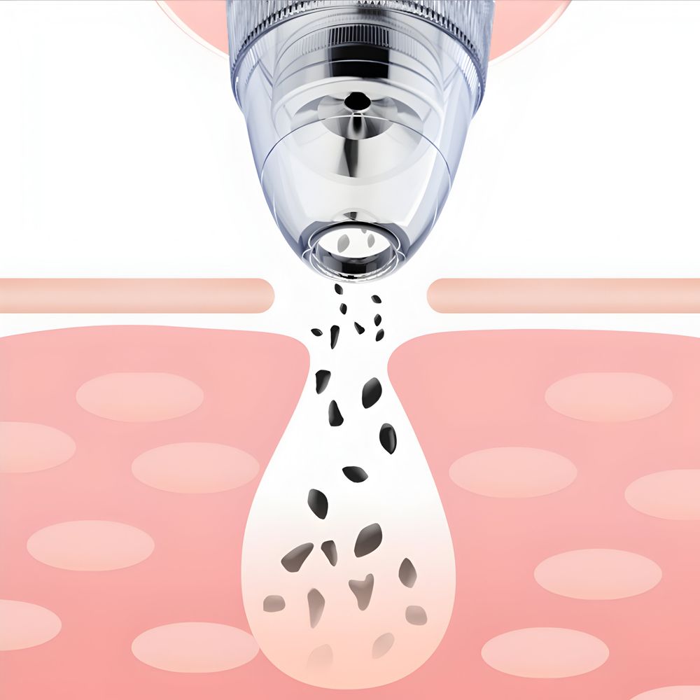 Porenreiniger Electric Mitesser Mitesserentferner Vakuum Cleaner Pore Cleaner Gesicht Reinigung mit LED-Bildschirm und 4 Sonden und 3 Modi Weiß Retoo