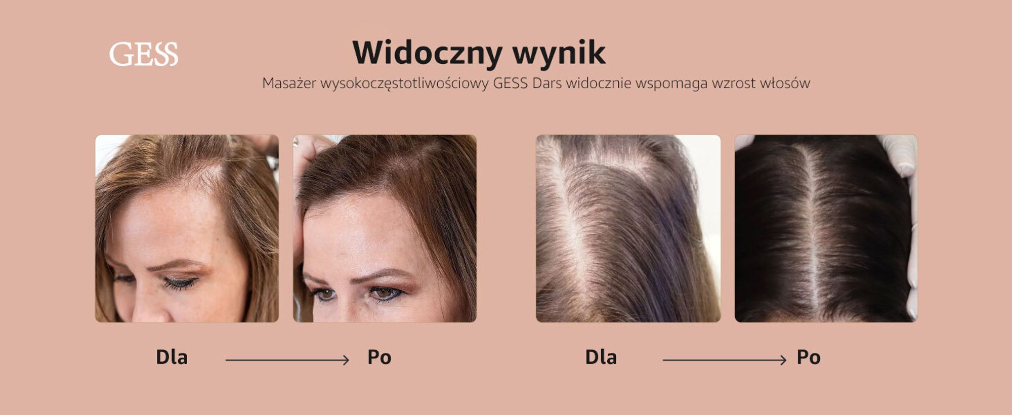 Darsonval, wysoka częstotliwość, leczenie włosów, przeciwdziałanie wypadaniu włosów, kosmetyczne urządzenie do twarzy, pielęgnacja skóry GESS Dars