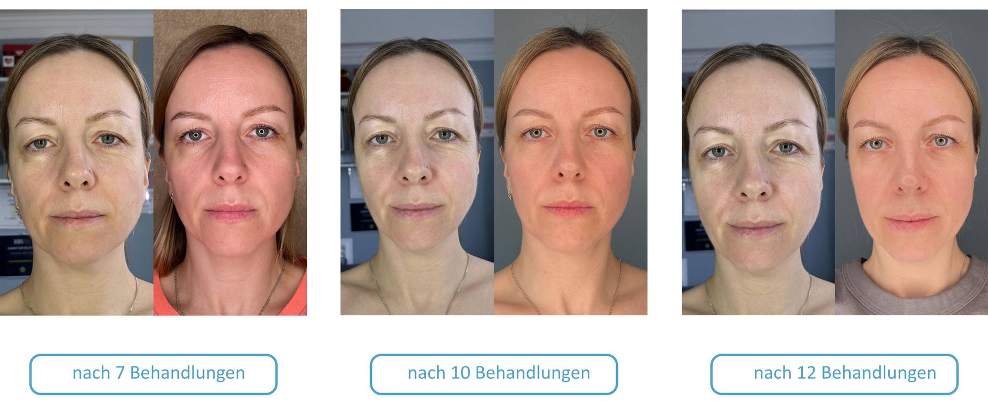 GESS FaceActive Premium BMS Gesichtsmassagegerät - Anti-Aging, Faltenreduktion & Hautstraffung
