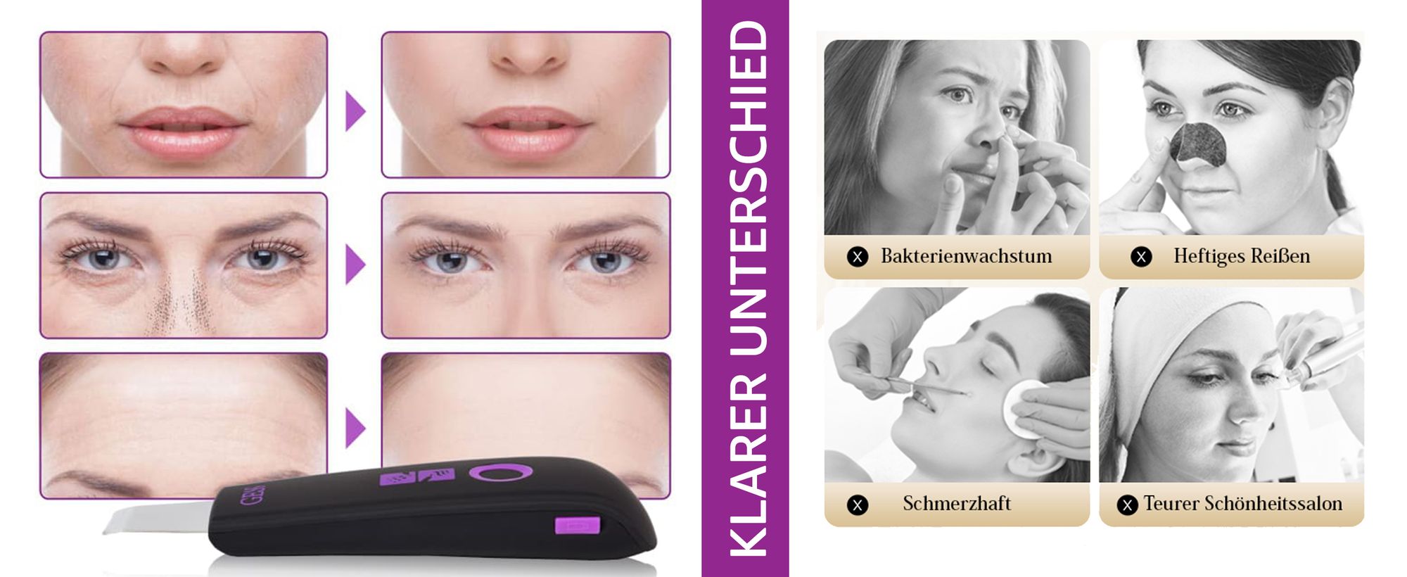 Ultraschallreinigungsgerät, Gesichtsreiniger, Mitesserentferner Porenreinigung Akne-Peeling, Mikrodermabrasion, Hautpflege, Massage, aufladbar GESS YOU