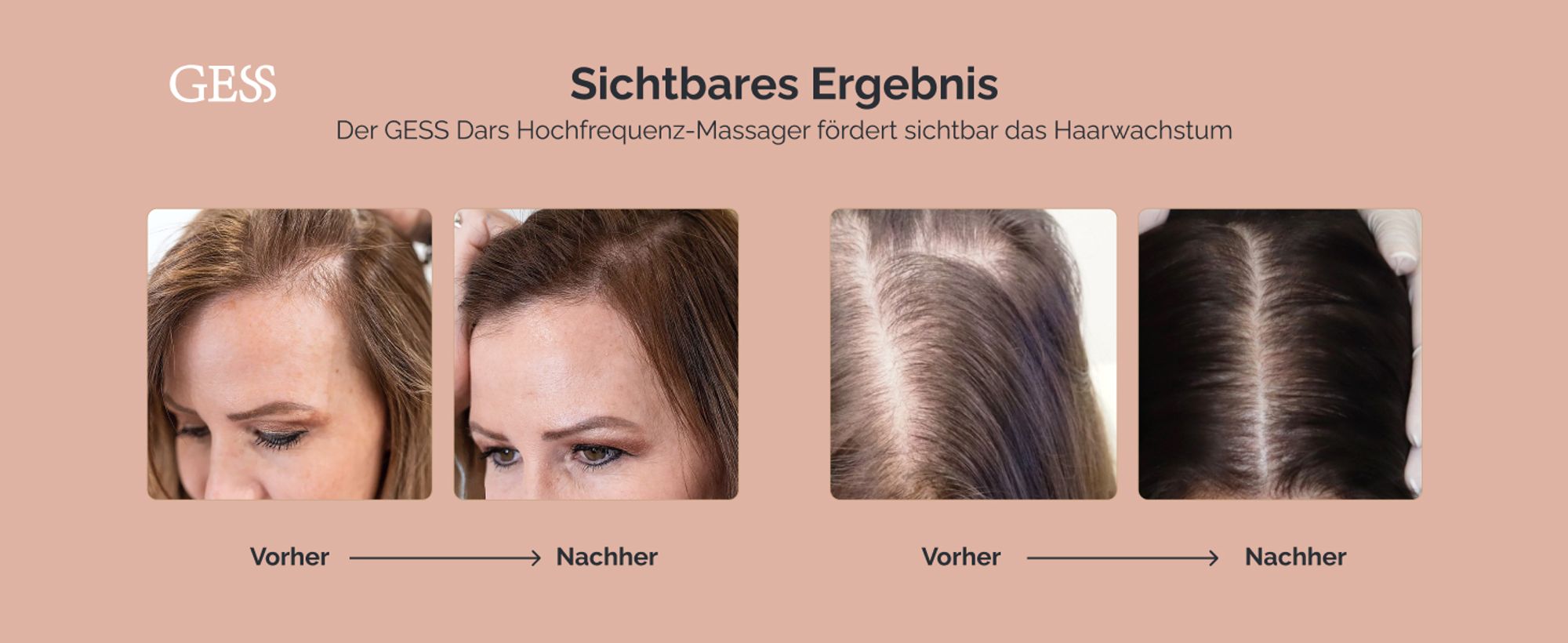 Darsonval, Hochfrequenz, Haarbehandlung, Anti-Haarausfall, kosmetisches Gesichtsgerät, Hautpflege GESS Dars
