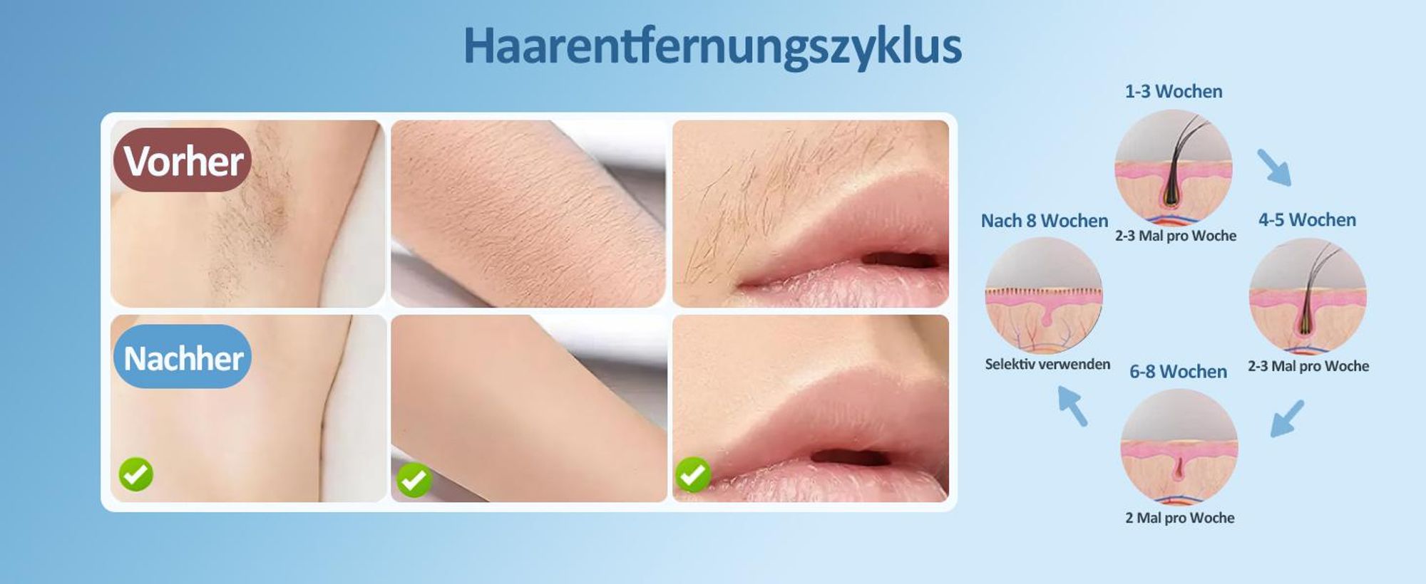 KUGI Haarentfernungsgerät IPL Geräte Haarentfernung mit Kühlfunktion 999.999 Blitzen– Laser Haarentfernung mit 5 Energiestufen