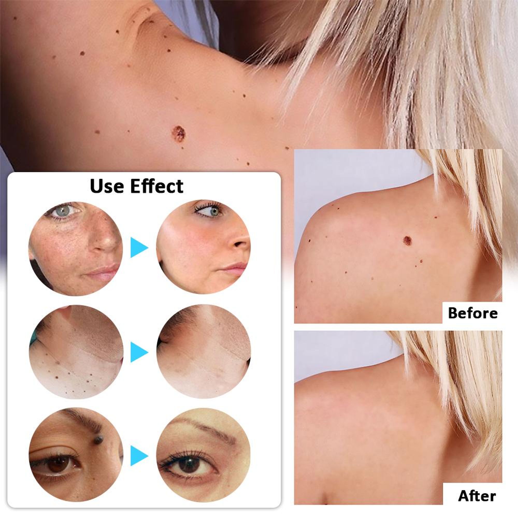 Laser Plasma Stift zur Entfernung von Hautflecken, Hautanhängseln, dunklen Flecken, Warzen, Muttermalen, Tattoos, Sommersprossen und Papillomen