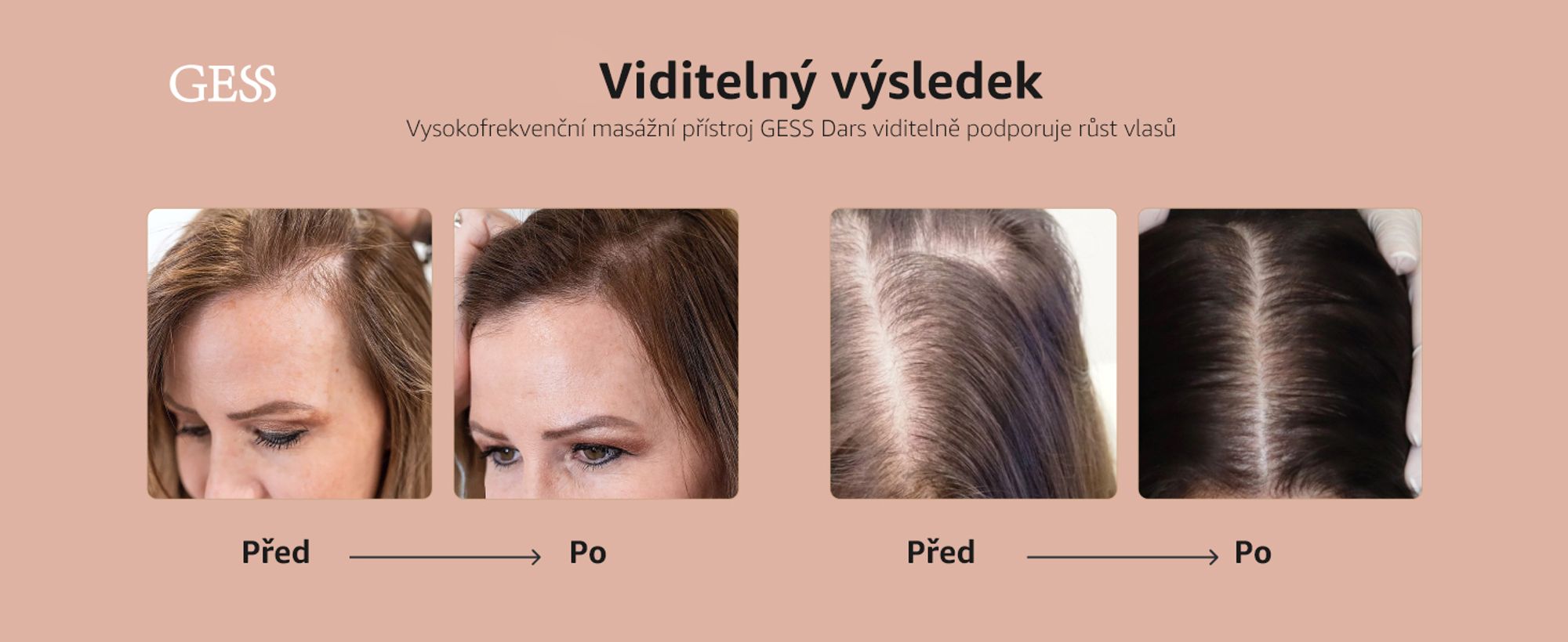 Darsonval, vysoká frekvence, léčba vlasů, proti vypadávání vlasů, kosmetický přístroj na obličej, péče o pleť GESS Dars
